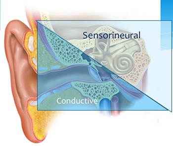 24-feb-2022-what-is-hearing-loss-and-is-it-reversible